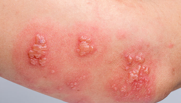 Blisters