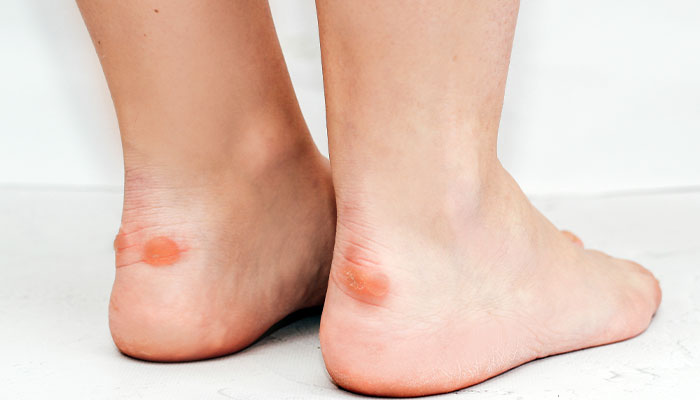 Calluses