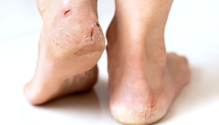 Foot Ulcers