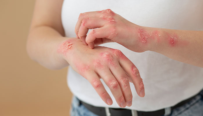 Autoimmune Disease